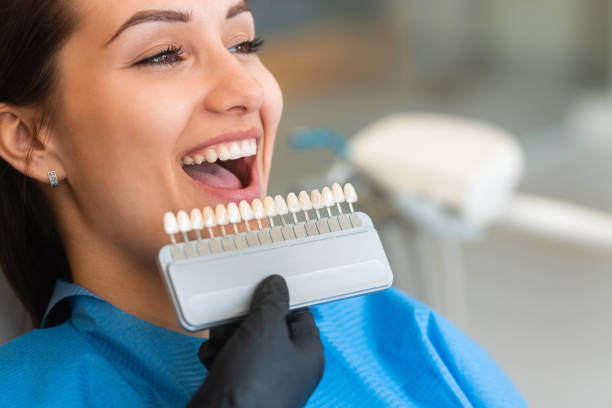 Unlocking Your Smile’s Potential with Veneers
